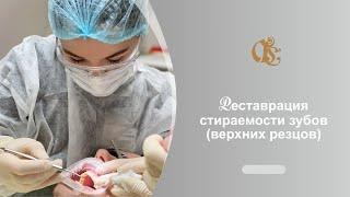 Реставрация стираемости верхних Резцов. Стоматология в Санкт-Петербурге.