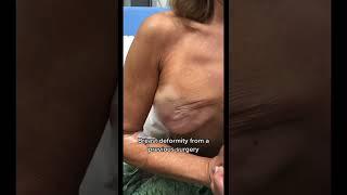 OMG! This Poor Patient's Chest Deformity 