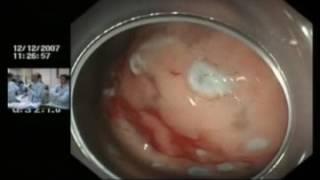 Live demonstration: ESD technique for a gastric neoplasm