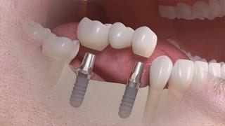 Straumann - Trattamento di più denti su impianto