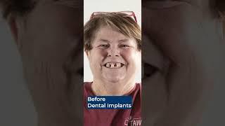 Before and After Nuvia's Permanent Teeth in 24-Hours! 