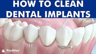 Dental floss and waterfloss - How to clean dental implants ©