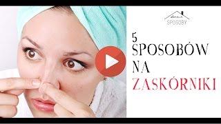 5 domowych sposobów na zaskórniki | Naturalne metody na wągry | cz.2