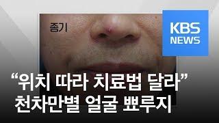 [5분 건강 톡톡] 얼굴 뾰루지도 천차만별…코밑 함부로 짜지 마세요! / KBS뉴스(News)