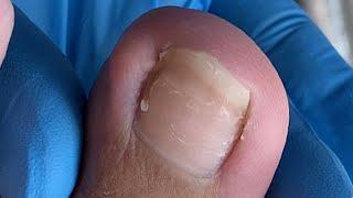 Step by step - how to cut ingrown nail by professional【辥一刀】