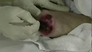 Wound Debridement Methods & Techniques | Wound Healing | WoundEducators.com