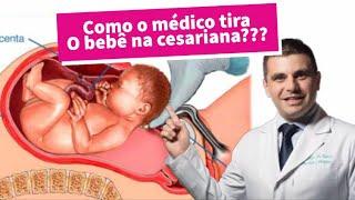 Como o médico tira o bebê na cesariana?