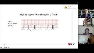 L’INTERPRETAZIONE DELL’ELETTROCARDIOGRAMMA NELL’ATLETA:COSA C’E’ DA SAPERE