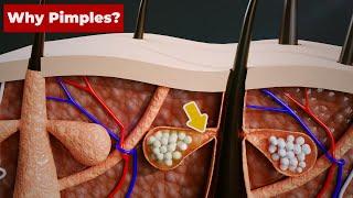 Why do we get PIMPLES? (3D Animation) #Shorts