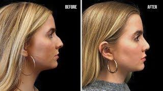 Sydney's Rhinoplasty at Marvel Cosmetic Surgery