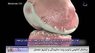 ساختار آناتومی زانو و روند ساییدگی و ارتروز مفاصل| متخصص ارتوپد | دکتر محمدابراهیم طاهریان