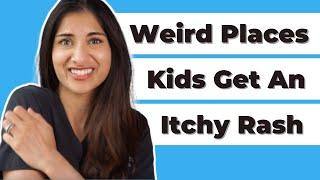 Weird Places Kids Get An Itchy Rash | Dr. Amna Husain