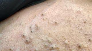 Luna Deep Cleansing Techniques For Acne (Glowing Skin Solutions)