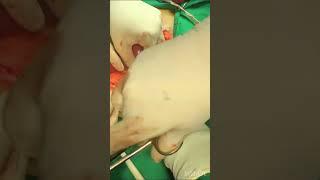 Adhesiolysis Surgery Laparotomy