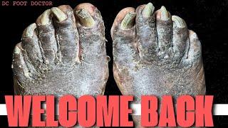 Welcome Back!  - Fungal Toenails and Severe Fungal Dermatitis