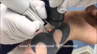 Laser Tattoo Removal Burke, VA @ Skin Deep Laser Services