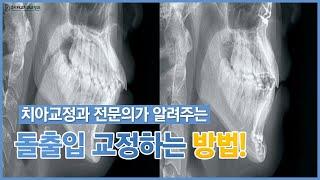 [영종시카고치과교정과] 교정과 전문의가 말해주는 돌출입 교정 방법!