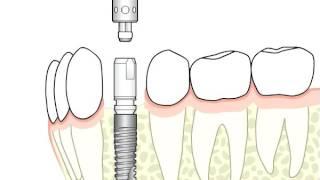 Ankylos™ – surgical and prosthetic procedure | Dentsply Sirona