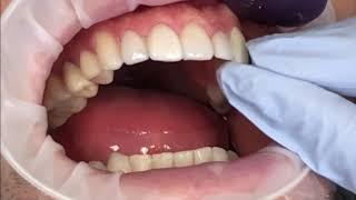 Cementing Veneers