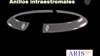 Anillos intraestromales