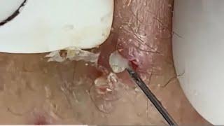 Massive Blackheads Removal #23