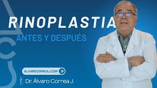 Rinoplastia Conservadora del Dorso: Técnica para Resultados Naturales