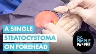 A Single Steatocystoma on Forehead