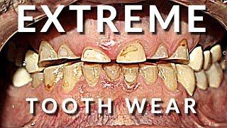 Extreme Smile Makeover - Full Mouth Dental Crowns and Veneers