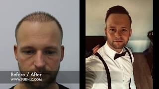 Hair Transplant Before and after, Repair with 4300 Grafts | Unbelievable Result