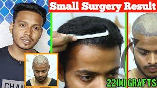 2200 Grafts Implants in MINIMUM Cost- $0000 ll HairTransplant ll Result AFTER 6 Months