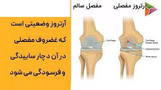 آرتروز چیست؟