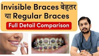 Invisible Braces बेहतर या Regular Braces? | Dr Ankit Khasgiwala Seraphic Dental, Indore