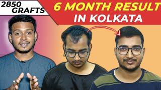 Hair transplant in kolkata || Best transplant result 2850 Grafts #hairtransplant