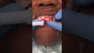 WHO HAS BRACES?! #shorts #bracesoff #orthodontist #shullmanorthodontics