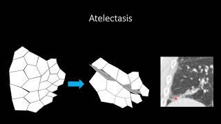 Atelectasis