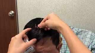 Zhu's Scalp Acupuncture For Right Upper Limb Trauma Fracture