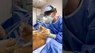 Another day, another gynecomastia surgery #beverlyhillsplasticsurgery #gynecomastiatreatment