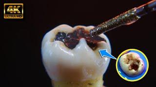 AMAZING process of dental restoration, step by step in 4K