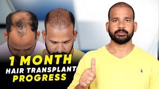 Hair Transplant in Udaipur | Best Results & Cost of Hair Transplant in Udaipur