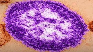 Measles confirmed in unvaccinated Montgomery County child; other people may have been exposed