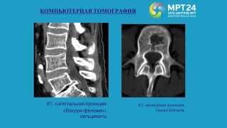 Дегенеративные изменения позвоночника на МРТ