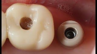 Flapless surgery using Dentium Digital Guide(Dr. Tae-Hyung Kim's commentary)