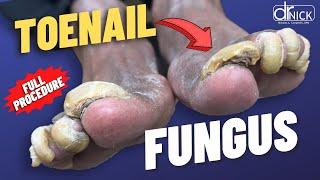 Cutting THICK fungus TOENAILS!