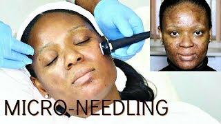MICRO-NEEDLING MY ACNE SCARS & HYPERPIGMENTATION | OMABELLETV