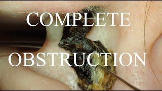 COMPLETE OBSTRUCTION CAUSED HEARING LOSS