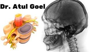 Craniovertebral junction surgery(Dr. Atul Goel)