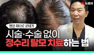 시술, 수술 없이 정수리탈모 치료하는 방법ㅣ뉴헤어