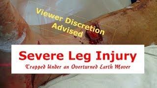 Severe Leg Injury and Deformity (Viewer Discretion Advised)