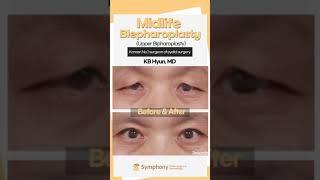 Middle aged Droopy eyelid surgery (Blepharoplasty, Lifting), which hospital should you choose?