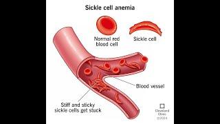 The Impact of Sickle Cell and How it affects Africans